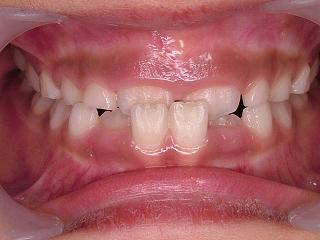 混合歯列期(phase1)の矯正: 埼玉・大宮の歯医者・矯正歯科なら「すずき 