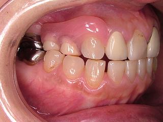 膜 炎 歯根 あごの骨が溶けてしまう危険性もある「歯根膜炎」ってどんな病気？