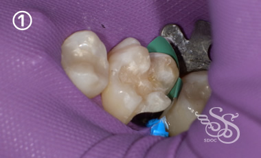 できるだけ歯を削らない治療1