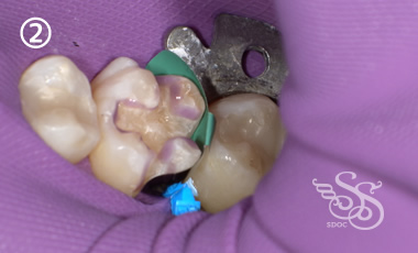 できるだけ歯を削らない治療2