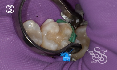 できるだけ歯を削らない治療3