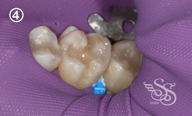 できるだけ歯を削らない治療4