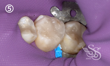 できるだけ歯を削らない治療5