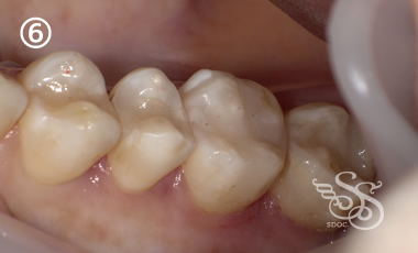 できるだけ歯を削らない治療6