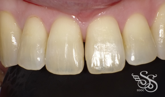 ダイレクトラミネートべニア術前