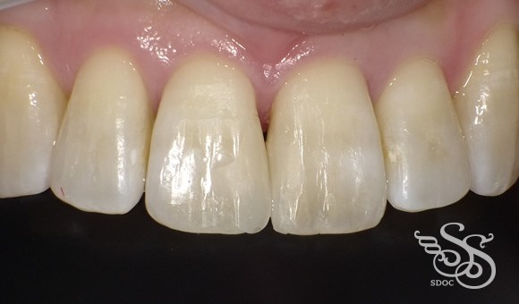 ダイレクトラミネートべニア術後