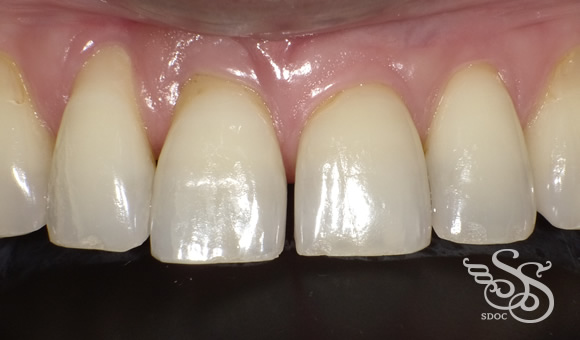 ラミネートべニア術前