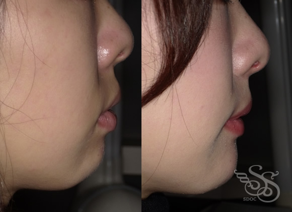 口元横顔ビフォーアフター