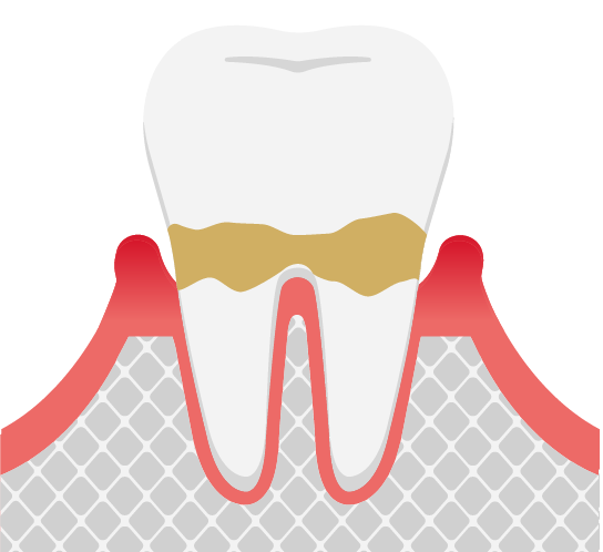 軽度歯周病