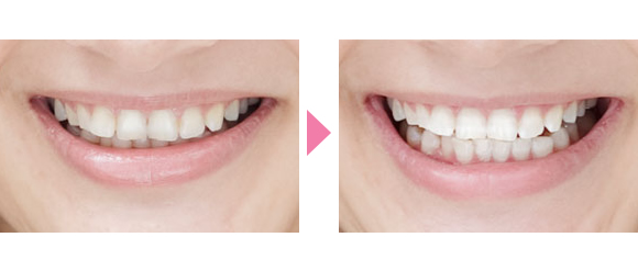 ホワイトニング術前術後